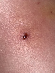 Is this cat bite infected??