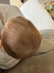 Plagiocephaly