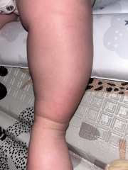 Could this be a peanut allergy?!