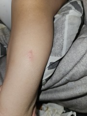 Spider bite? What are these marks?