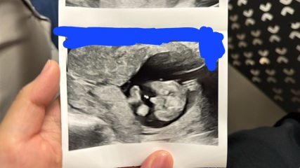 Nipt says girl, but ultrasound says boy!