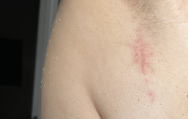 Rash under arm / breast