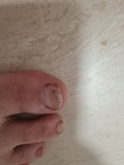Is this fungal nail infection or something else