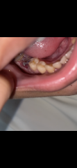Tooth Extraction Healing
