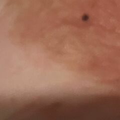 Black spot/ mole on my nipples, help! Pregnant
