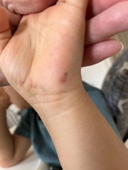 WWYD if your dc came home from nursery with these bruises?