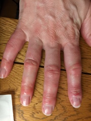 Help pls, possible autoimmune