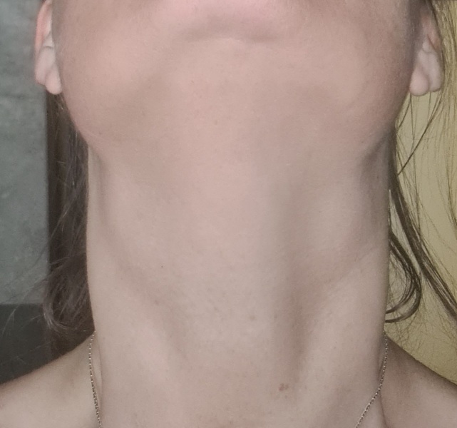 Two swellings in my throat