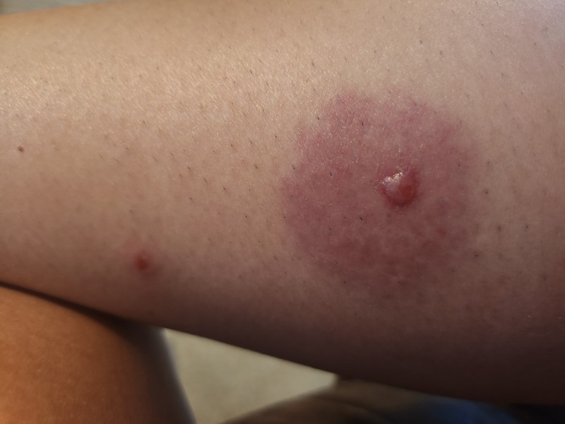 Infected mosquito bite?