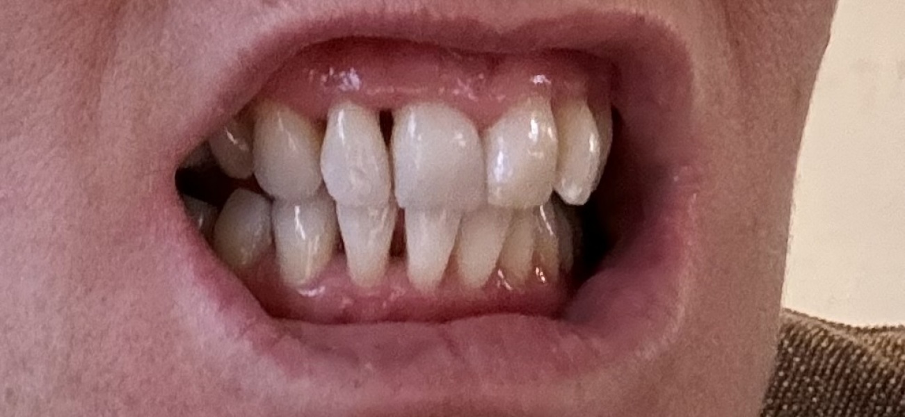Awful gums (pic included)