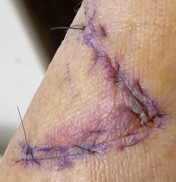 Is this incision okay? Trigger warning: minor surgery photo
