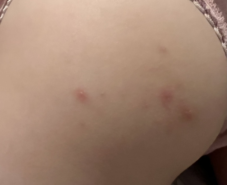 Chicken pox?