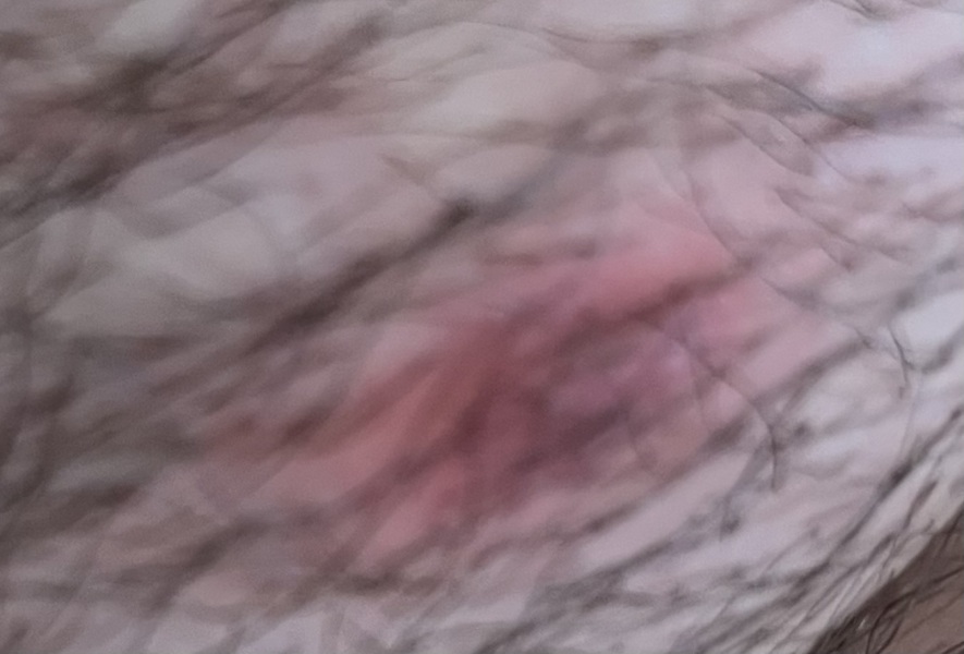 Boil? Infected hair? Help!