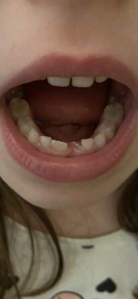 Crooked tooth (picture included)