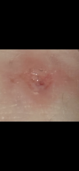 To be worried about this on my leg