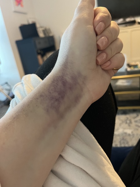 Does this look like a clot or a bruise