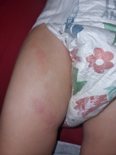 Does anyone know what this rash is and how to treat?