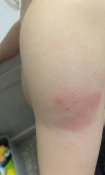To worry about my daughter's arm after vaccinations?