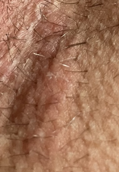 What’s this in my groin? *TMI alert*