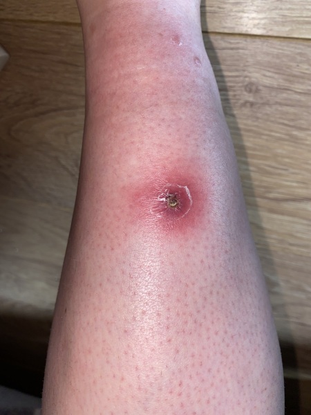 Insect bite just won’t heal - help!