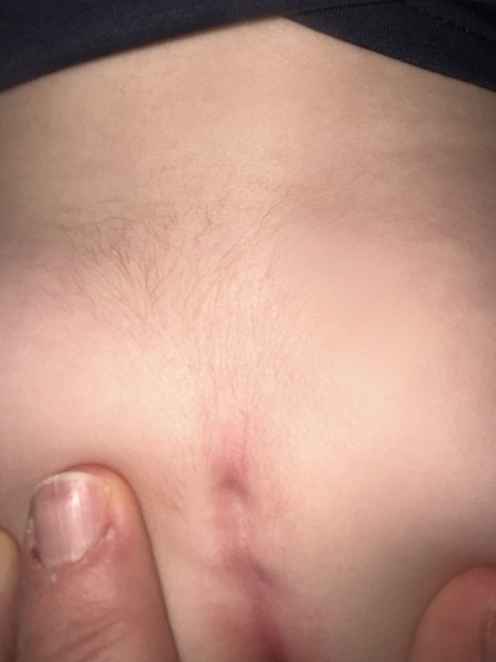 Sacral dimple with hairy tuft