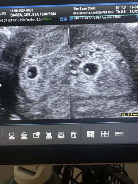5 week scan, no yoke sac