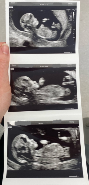 Nub theory - boy or girl? 💙💖