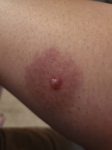 Infected mosquito bite?