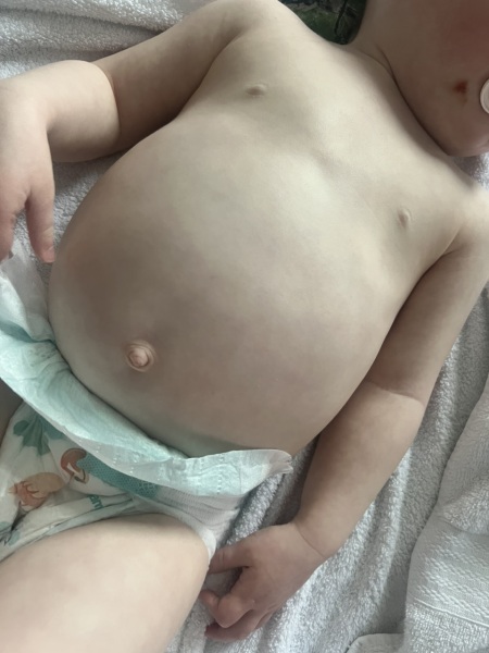 Toddler swollen belly?