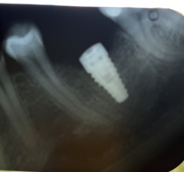 Dentists please help- is this an abscess?