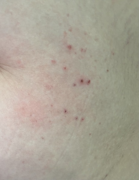 What is this rash :(