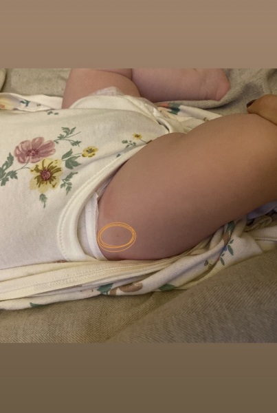 2 Month Baby Vaccinations - Site of injection correct?