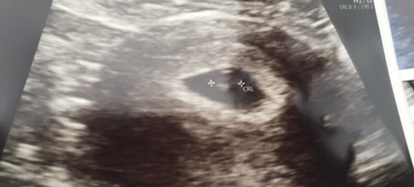 Abdominal scans at 6wks what did you see