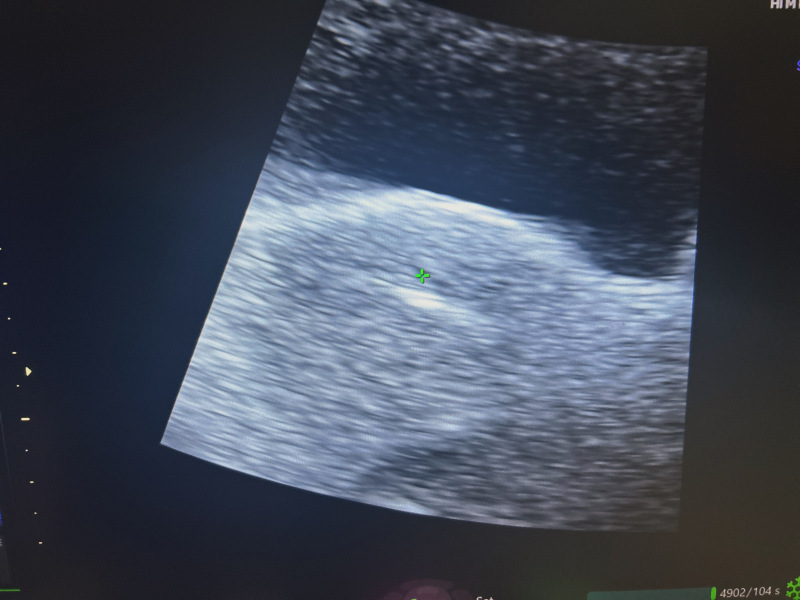 IVF Transfer September 2024 ICSI