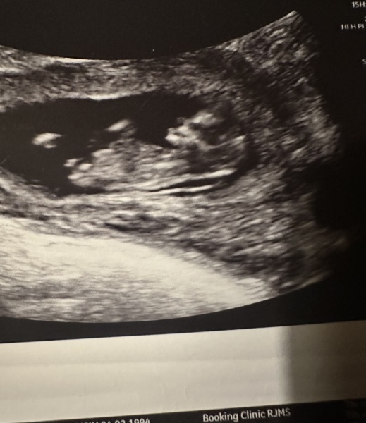 Nuchal fold measuring 3.8mm at 11 weeks