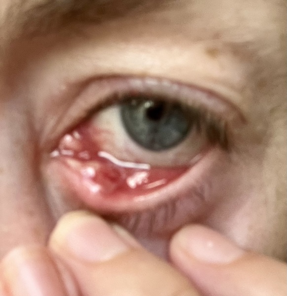 To go to hospital (XX gross photo attached)