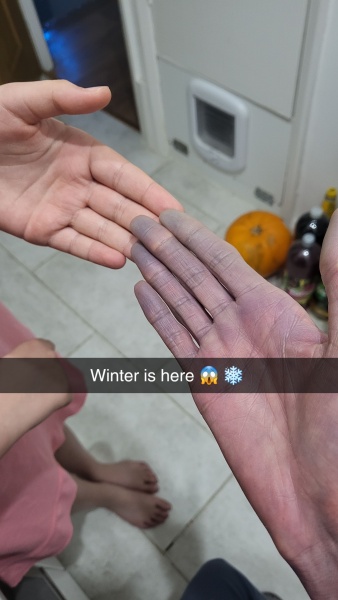 My Raynaud's is out of control! 🥶