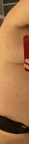 Is this chicken pox? << TW pics included >>