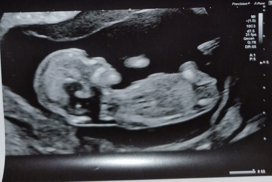 12 week scan gender guess