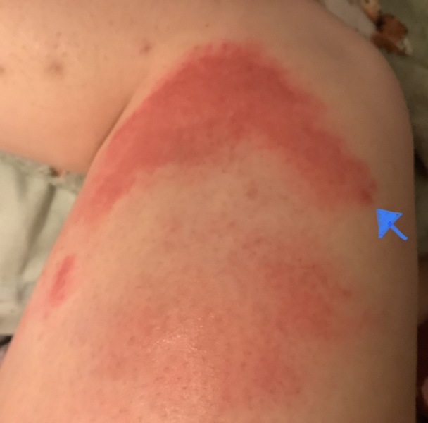 What the puff is this rash? (Photo)