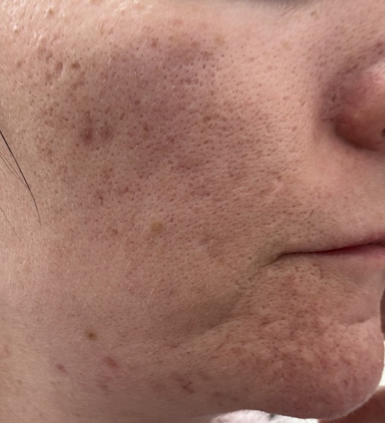 Never felt worse about my skin and I want to cry (photo)