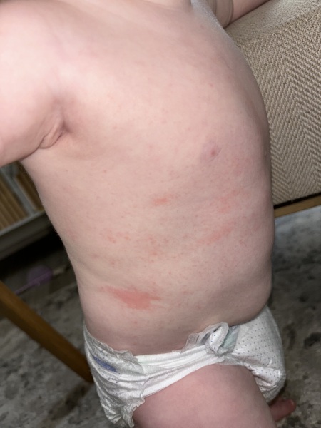 Confused with contact hives...allergy or not?