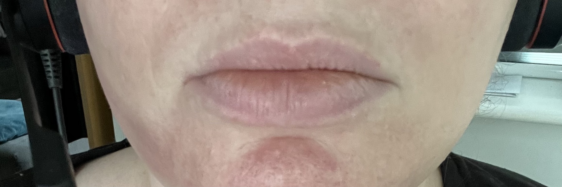 Lip shadow/melasma?