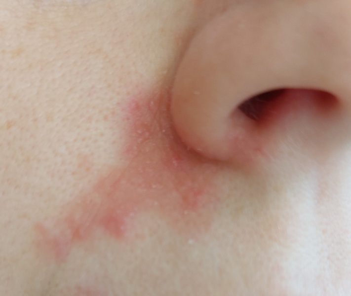 Patch on skin - worried