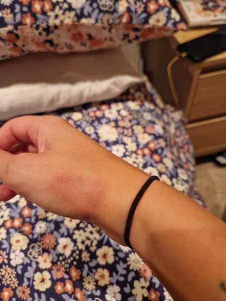 What could this mark on my hand be?