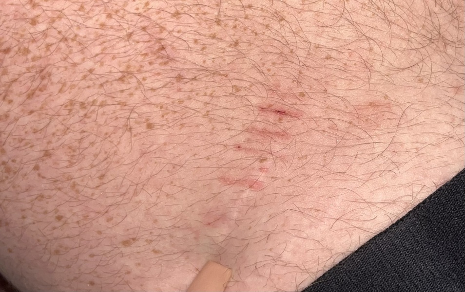 Do I have a Metronidazole allergy?