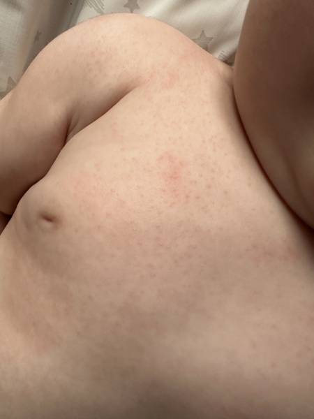 5mth old - rash after cold