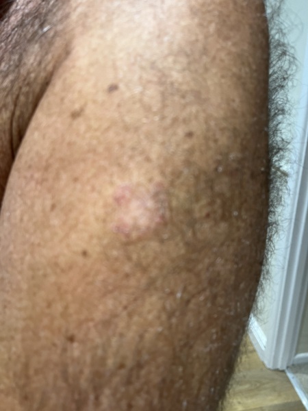 Is this ringworm?