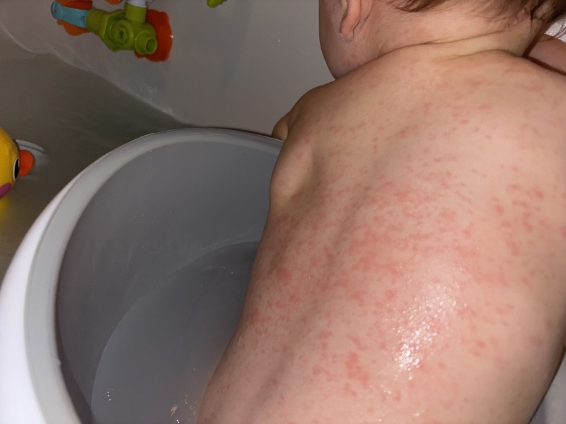 1 year old potentially has chicken pox. Wife pregnant with baby #2