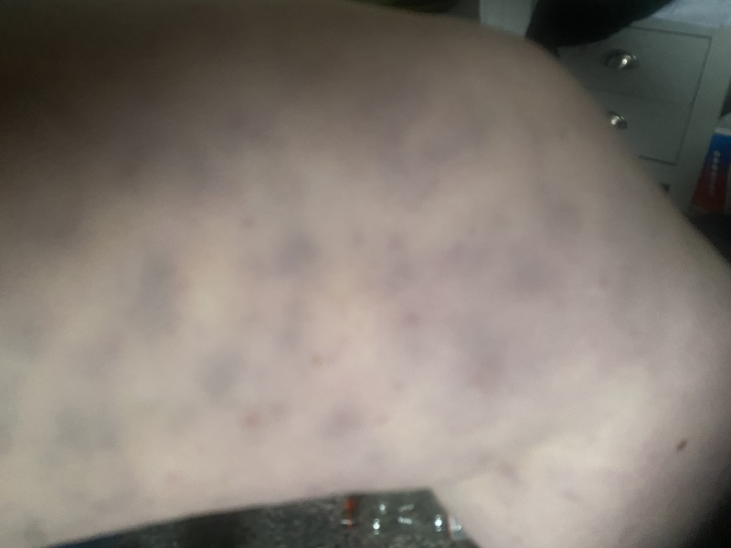 Random rash and bruises
